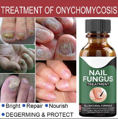 Natural Antifungal Oil for Damaged Nails