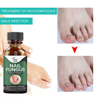 Natural Antifungal Oil for Damaged Nails