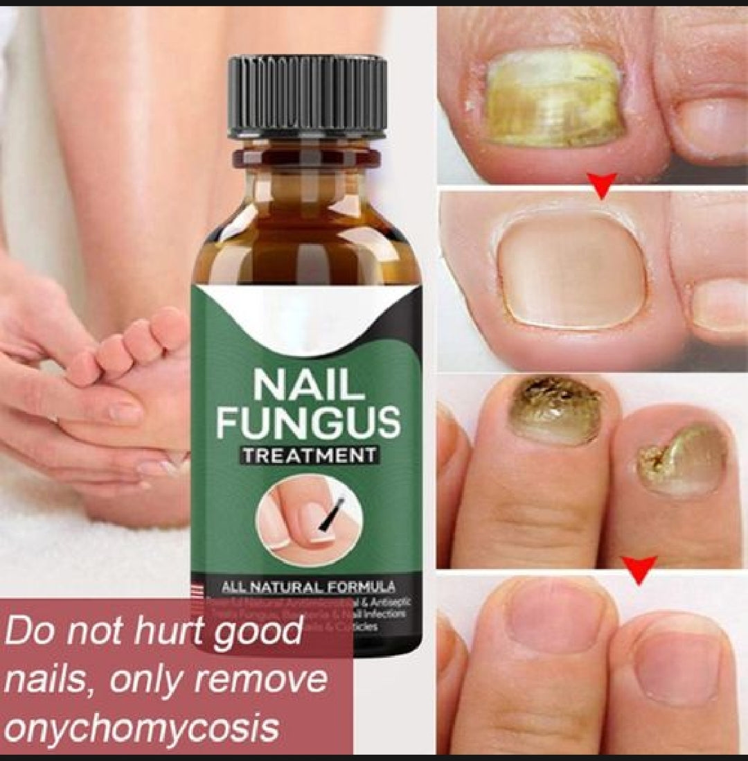Natural Antifungal Oil for Damaged Nails